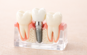 Comment se déroule la pose d’un implant dentaire ?